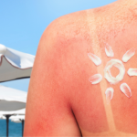 Sunburn treatment tips