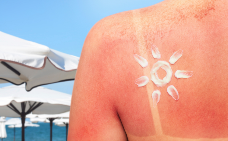 Sunburn treatment tips